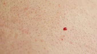 ما سبب ظهور حبوب حمراء في الجسم