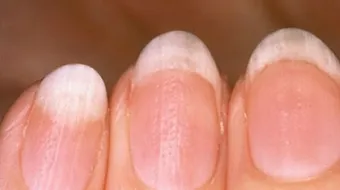 ما هو سبب ظهور بقع بيضاء على الأظافر