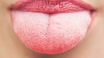 ما سبب بياض اللسان
