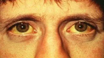 ما سبب اصفرار الوجه