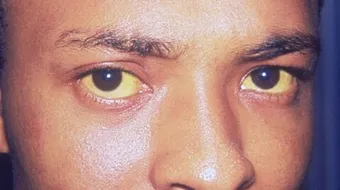 ما هو سبب اصفرار بياض العين