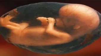 ما حكم اجهاض الجنين المشوه