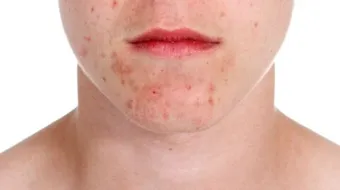 ما هو الحل لحب الشباب