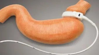 ما هي عملية تحزيم المعده