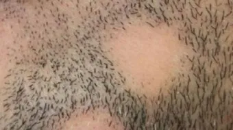 ما هو علاج الثعلبة في الذقن