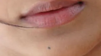 ما علاج السواد حول الفم