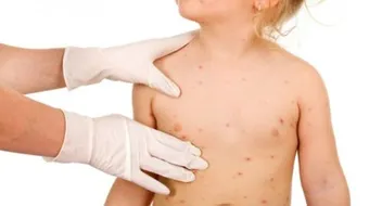 ما هو علاج جدري الماء عند الأطفال