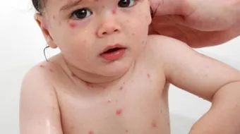 ما علاج جدري الماء