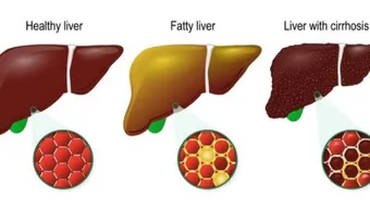 ما هو علاج تليف الكبد