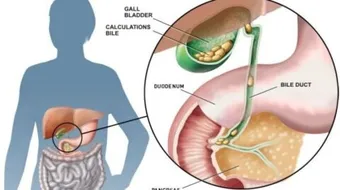 ما علاج حصوة المرارة