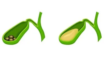 ما هو علاج حصوة المرارة