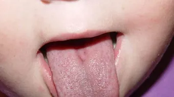 ما هو علاج ثقل اللسان