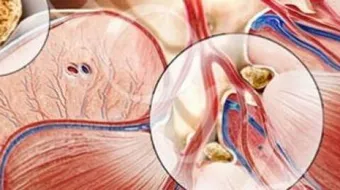ما علاج حصوة الكلى
