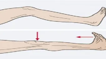 ما هو علاج شد العضل