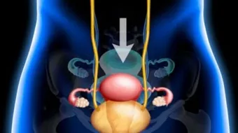 ما هو علاج هبوط الرحم