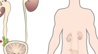 ما علاج احتقان البروستاتا