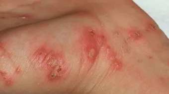 ما هو علاج الجرب