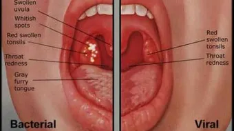 ما هو علاج احتقان الحلق