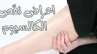 ما هو علاج نقص الكالسيوم