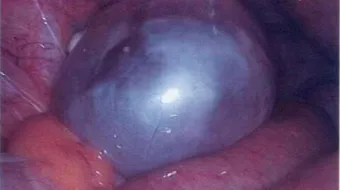 ما علاج الكيس على المبيض