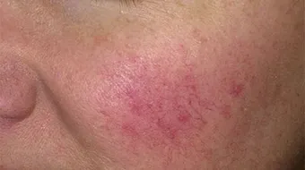 ما علاج حساسية الوجه