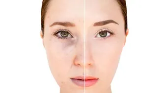 ما علاج تصبغات الوجه