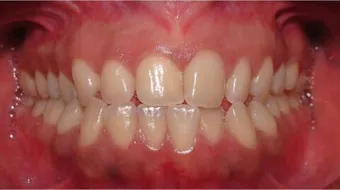 ما علاج اللثة الملتهبة