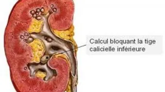 ما علاج حصى الكلى