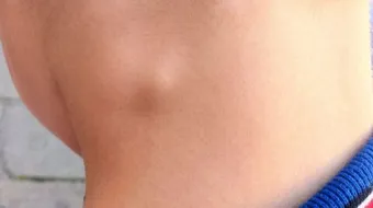 ما هو علاج الغدد اللمفاوية