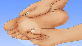 ما علاج مسمار اللحم في القدم