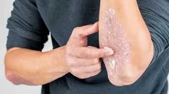 ما هو علاج الصدفية