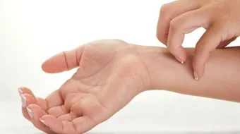 ما هو علاج مرض الجرب أو الحكاك - فيديو