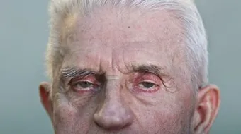 ما علاج التجاعيد حول العين