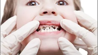 ما هو تسوس الاسنان