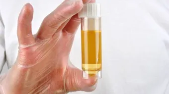 ما هو سكر البول