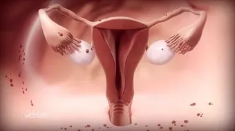 ما هو احتقان الرحم