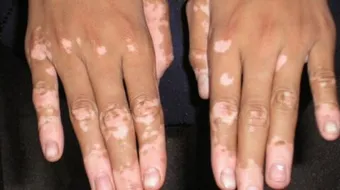 ما هو البهاق