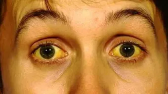 ما هو اصفرار العين - فيديو