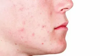 ما حل مشكلة حب الشباب