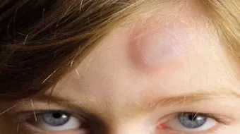 ما علاج الكدمات