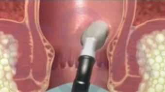 ما علاج البواسير