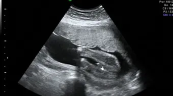 متى أعرف جنس الجنين بالسونار