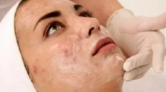 متى يختفي حب الشباب