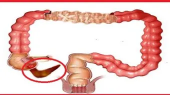 أين تقع الزائدة