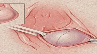 أين تقع غدة بارثولين