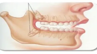 أين يقع ضرس العقل