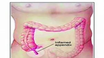 أين تقع الزائدة في جسم الإنسان