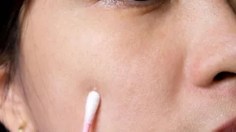 ظهور بقع بيضاء في الجسم