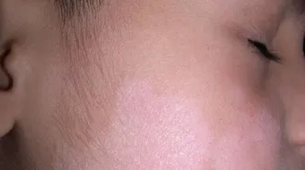 بقع بيضاء في الوجه