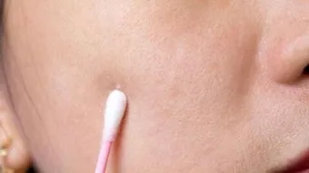 ظهور بقع بيضاء في الوجه